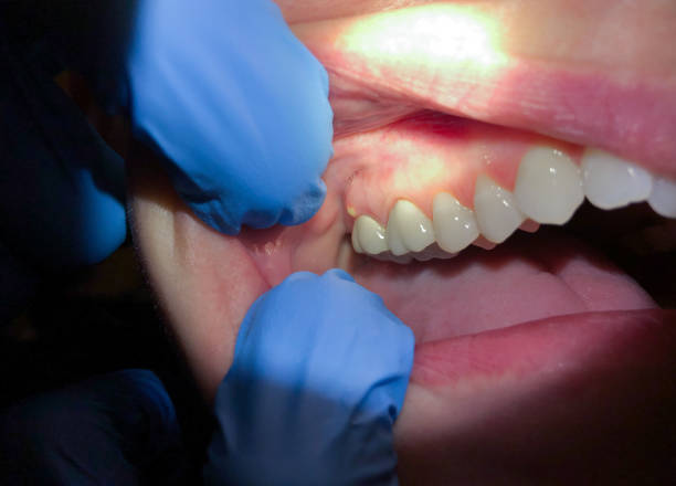 Best Emergency Wisdom Teeth Removal in Bayshe, OR